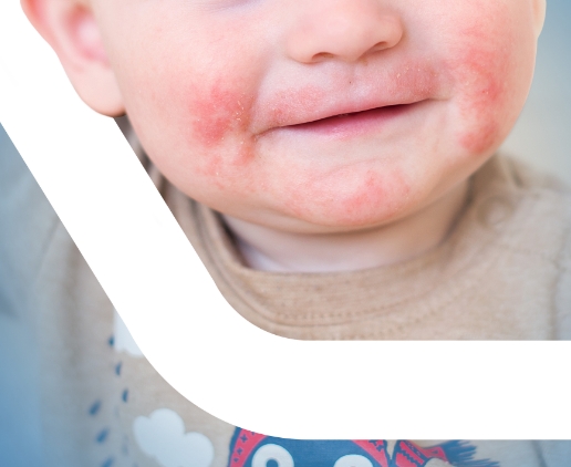 Close-up of photo of an infant showing the bottom half of the face with atopic dermatis rash