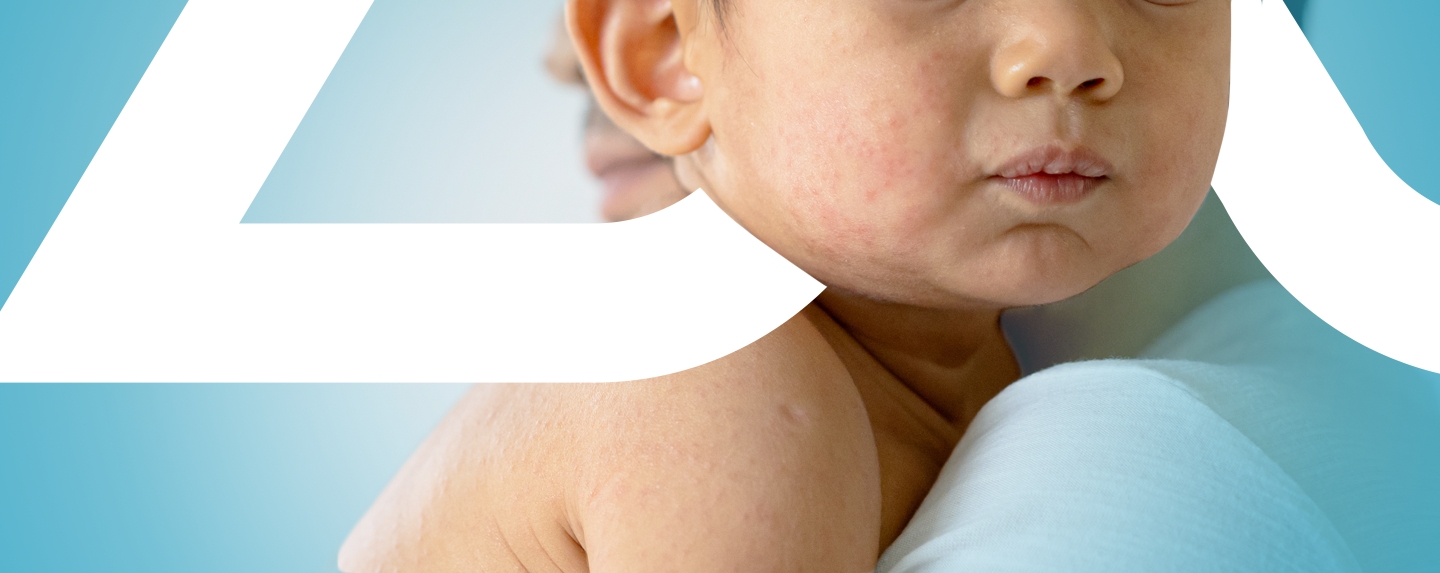 Close-up photo of adult holding infant with atopic dermatitis rash on face. Adult shoulder and chin are visible, aling with the lower half of the child’s face and shoulder.