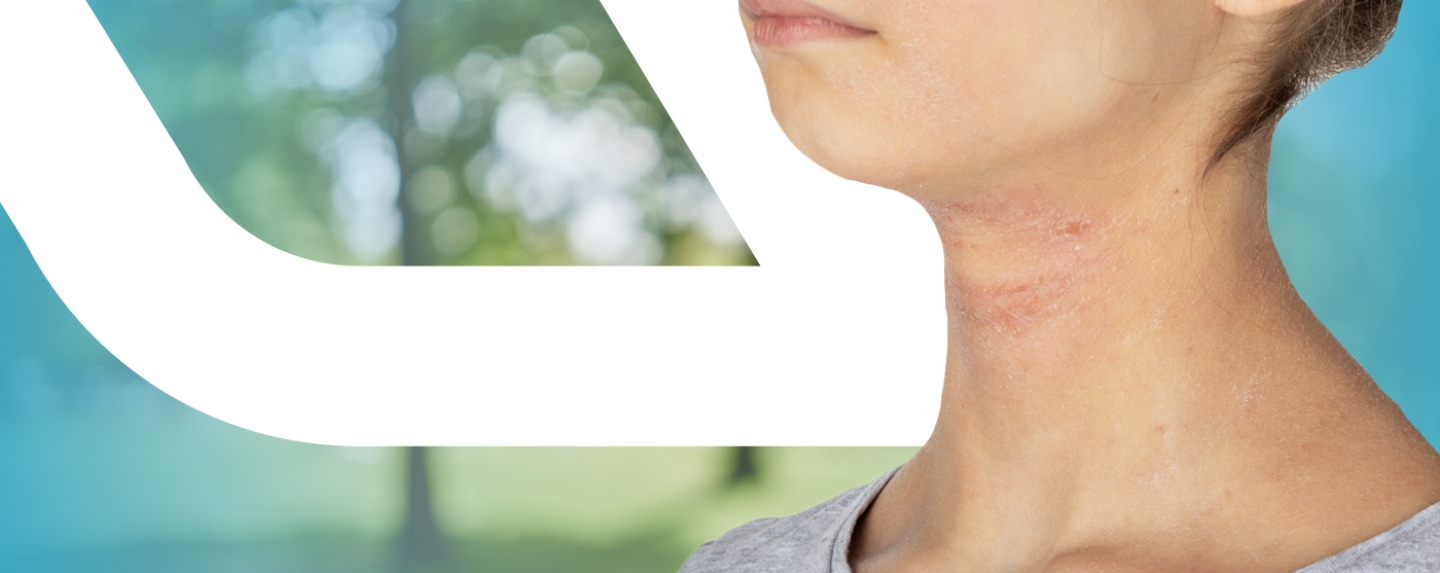 Close-up photo of woman’s neck with atopic dermatitis rash